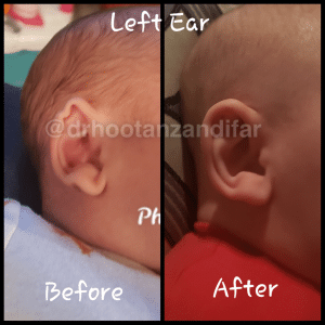 Left Ear Remolding Before and After