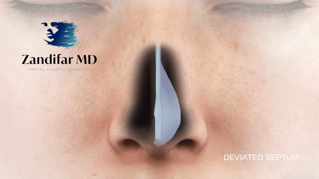 Digital Illustration of human nose with diagram of a deviated septum. Zandifar MD Logo with tagline facial plastic surgeon. Deviated septum is highlighted in black with white overlay illustration.