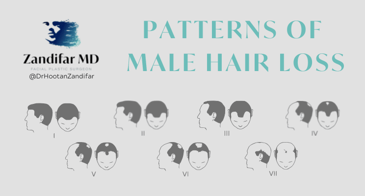 Image with title "Patterns of Male Hairloss" includes Zandifar MD Logo and social handle @DrHootanZandifar. Image depictions of Male Hairless according to the Norwodd Scale, starting with the hairline recession and progressing to a deep recession of the front and temporal hairline, as well as icons of back of the head male pattern baldness that grows and proceeds towards the front of the head. 