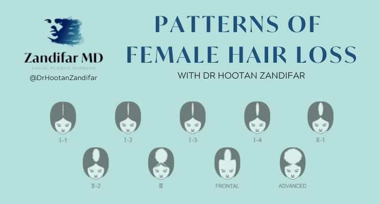 Patterns of Female Hair Loss