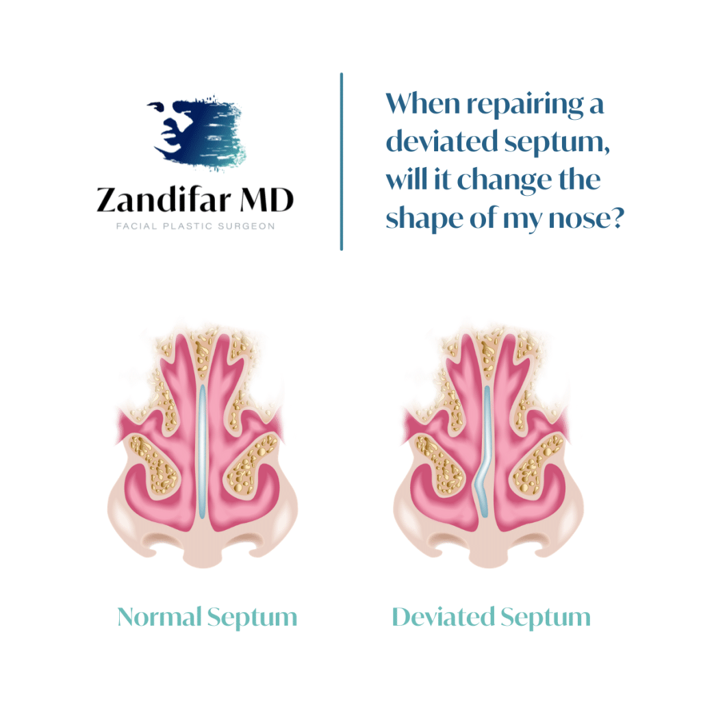 White background with ZandifarMD Logo in upper right corner. Depicted logo includes a face with paint brush stroke with a gradient color fade from navy blue to light teal. Logo reads "ZandifarMD" with the tagline that reads "Facial Plastic Surgeon". QUOTE: reads When repairing a deviated septum, will it change the shape of my nose?" Image is a depiction of the inside of a nose showing a normal septum on the left and a deviated septum on the right.