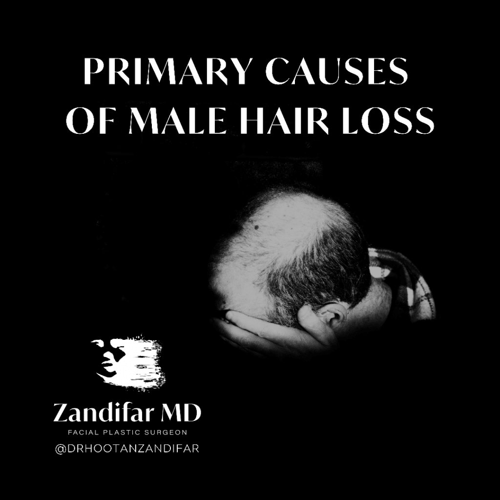 Headline reads: Primary Causes of Male Hairloss. Photo of Balding male with head in hands. Zandifar MD and Social Media handle included, reads Zandifar MD Facial Plastic Surgeon @DrHootanZandifar