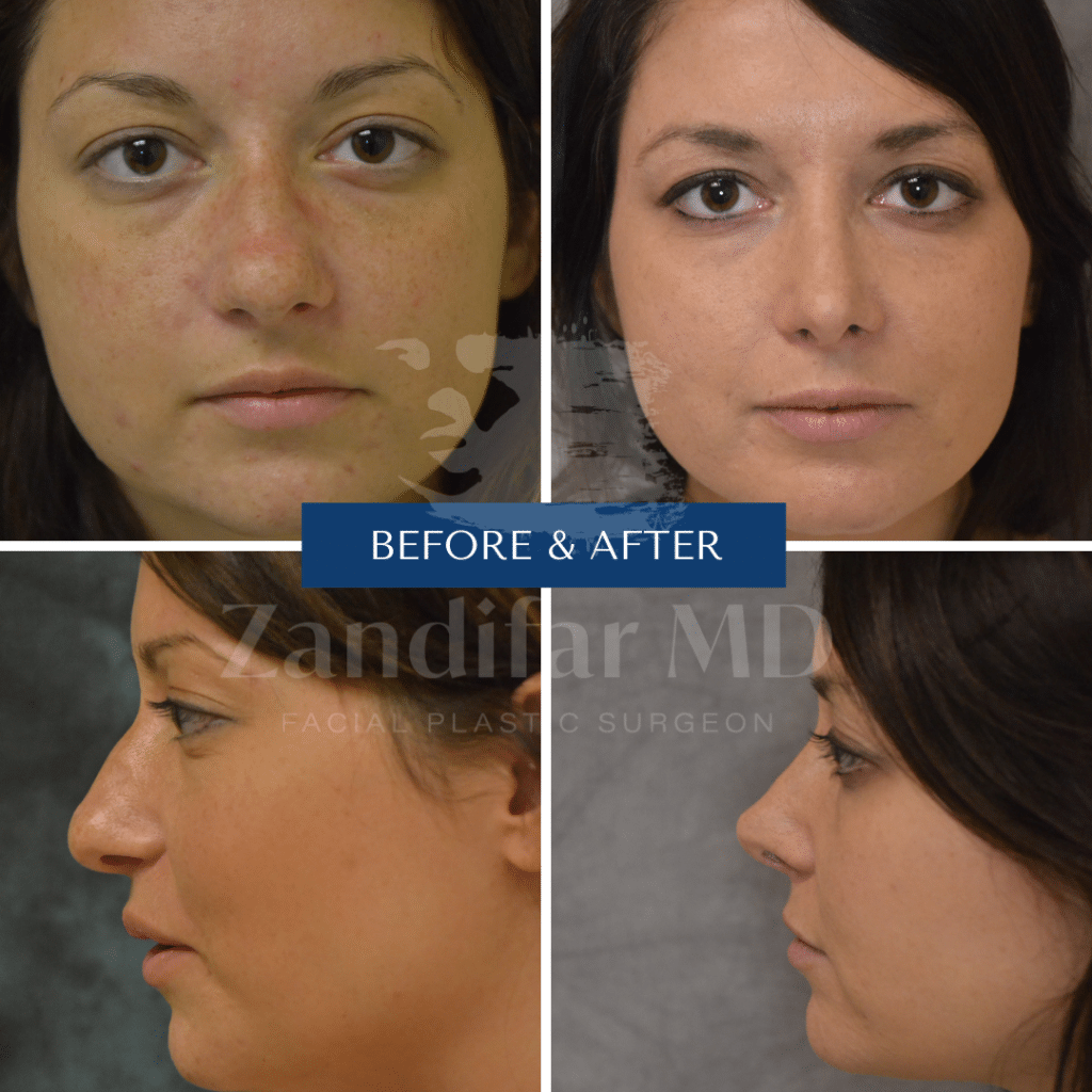Before and After image of a Rhinoplasty patient