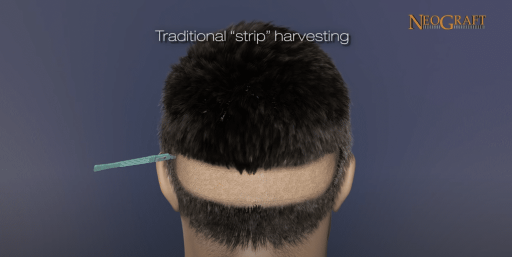 NeoGraft Hair transplantation with Dr. Hootan Zandifar