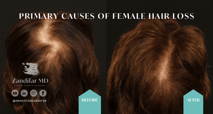 Before and after photos of female scalp. Left before photo shows hair recession along the middle part and thinning of hair. Right photos shows full head of hair after hair transplantation procedure by Dr. Hootan Zandifar. 