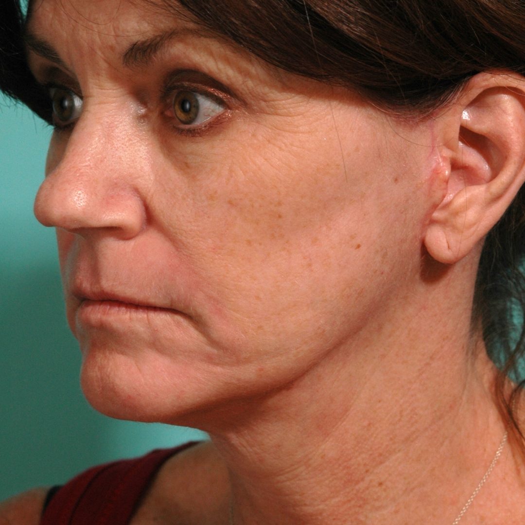 After image of a facelift