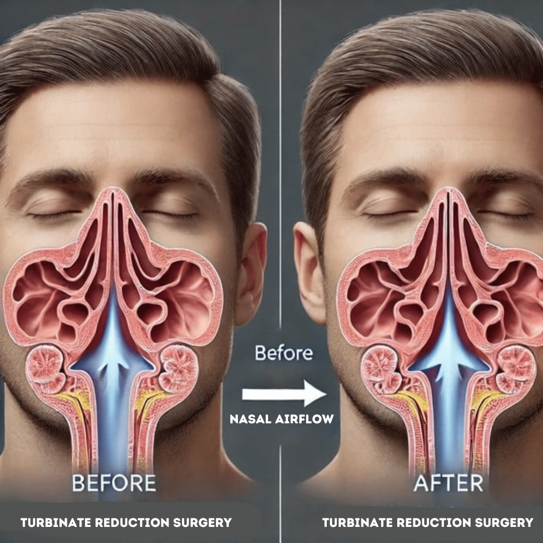 Benefits of Nasal Turbinate Reduction Surgery