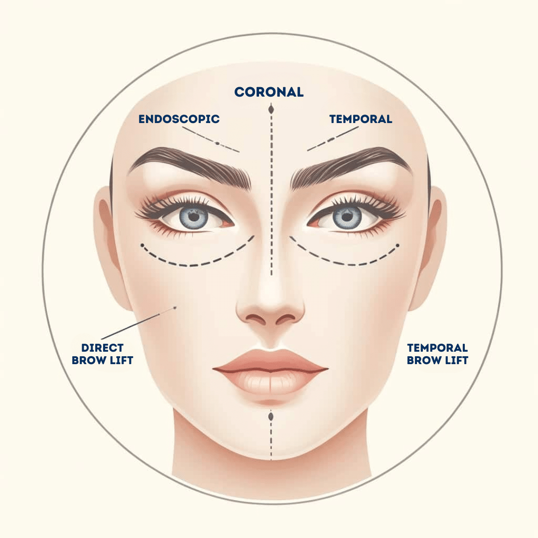 Types of Brow Lift Procedures