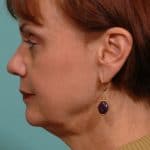 Facelift Lateral Before