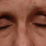 Upper Lid Blepharoplasty Closed After