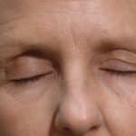 Upper Lid Blepharoplasty Closed Before