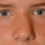 Closed Nasal Reduction Before