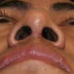 Deviated Septum After