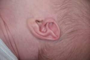 Ear Remolding Before