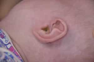 Ear Remolding After