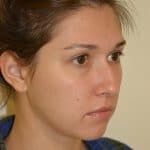 Female Rhinoplasty Oblique Before