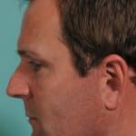 Facelift Lateral After