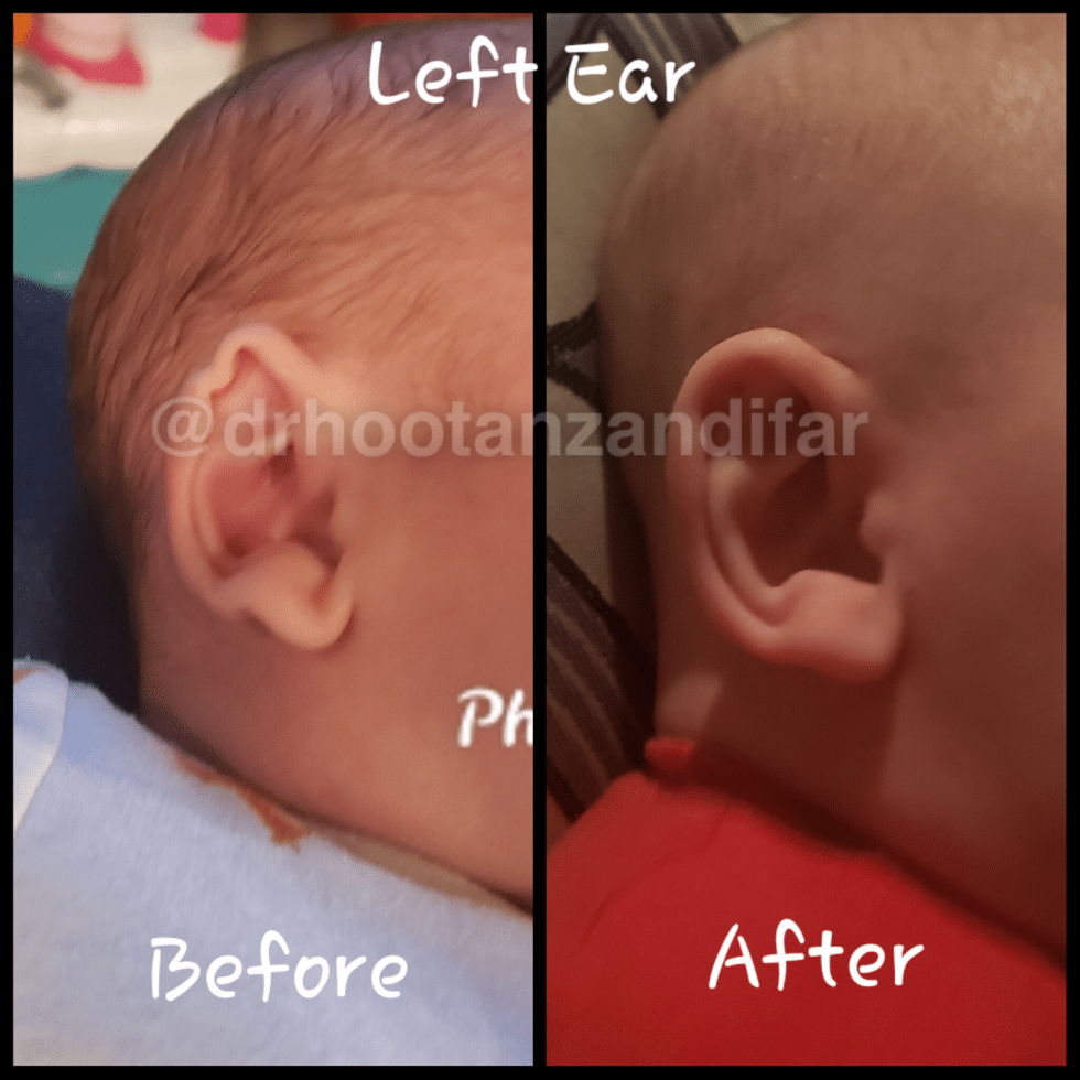 Category ear molding