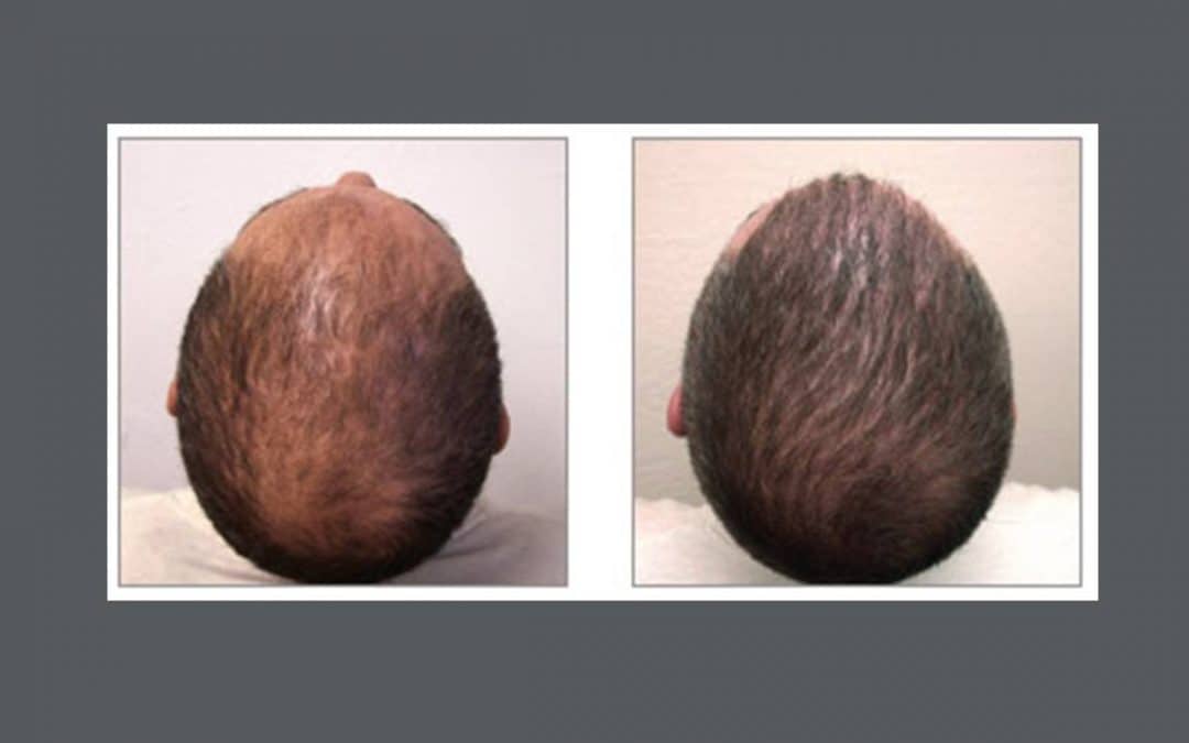 Recovery and Aftercare for Hair Transplants