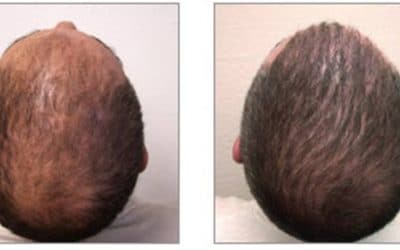 Recovery and Aftercare for Hair Transplants