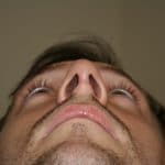 Nasal Valve Collapse After