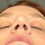 Repaired nasal valve, base view