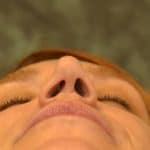 Nasal Valve Collapse repair Base view before