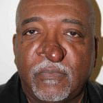 Rhinophyma Frontal Before