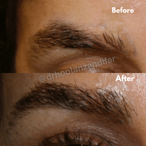 Eyebrow Transplant Before and After