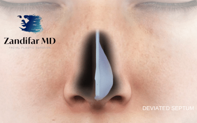 Signs You May Have A Deviated Septum