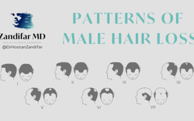 Patterns of Male Hair Loss with Dr. Hootan Zandifar