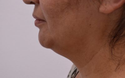 Facial Liopsuction vs. CoolSculpting