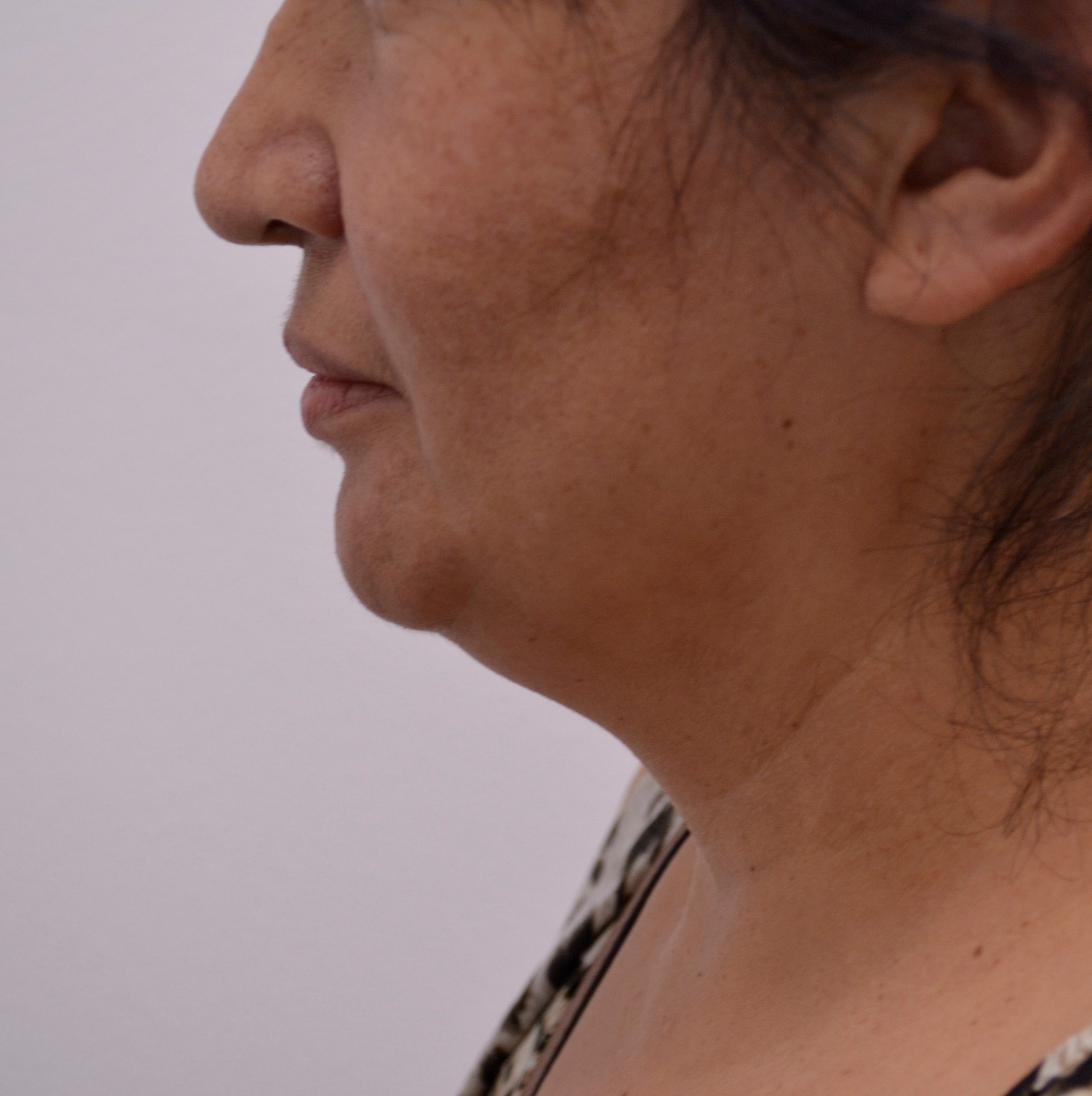 Facial Lipo Contouring Face Jaw & Neck Fat Removal Los Angeles