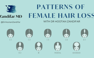 Female Pattern Baldness – Female Hair Loss Patterns and Treatment