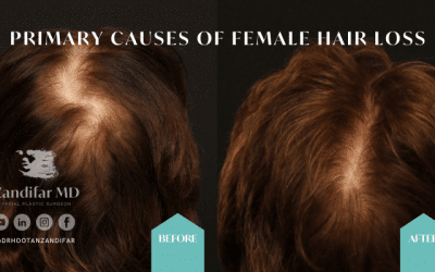 PRIMARY CAUSES OF FEMALE HAIRLOSS