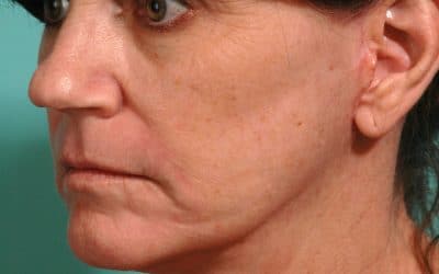 5 Benefits of a Facelift