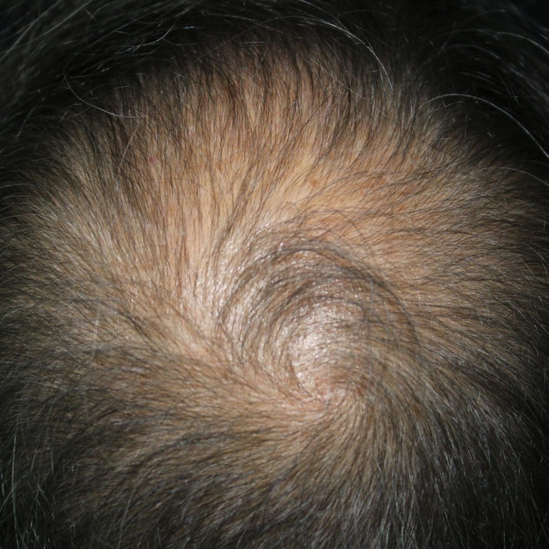 Hair Transplant after