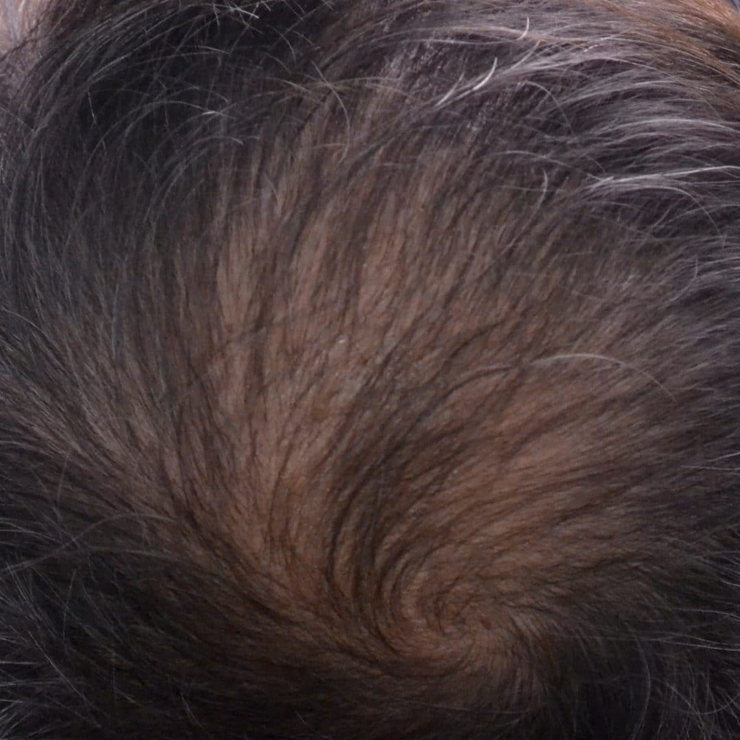 Hair Transplant after