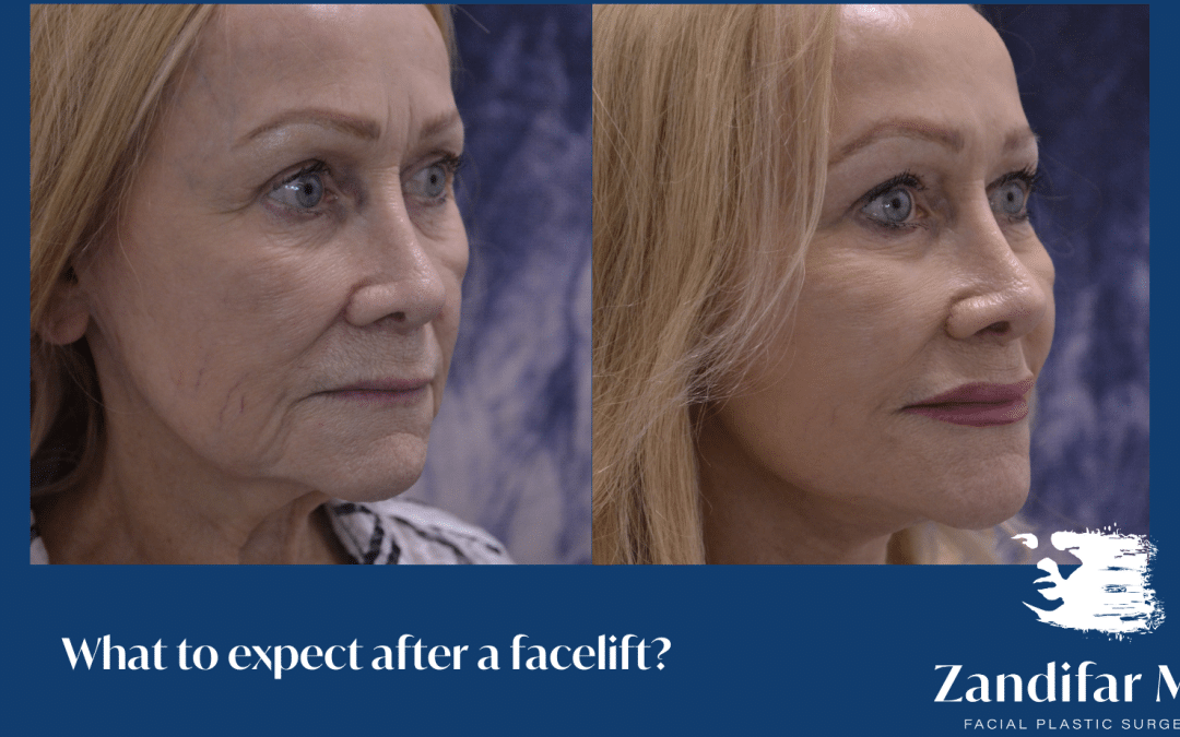 What To Expect After A Facelift