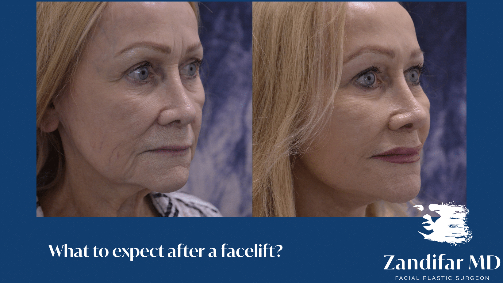 Facelift Aftercare Facelift Recovery Beverly Hills