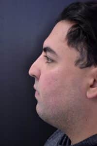 Male Nose Job Before Image
