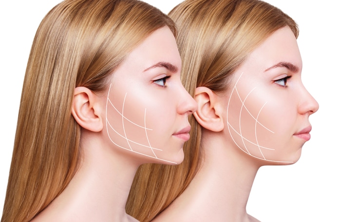 Exploring the Benefits of Chin Augmentation