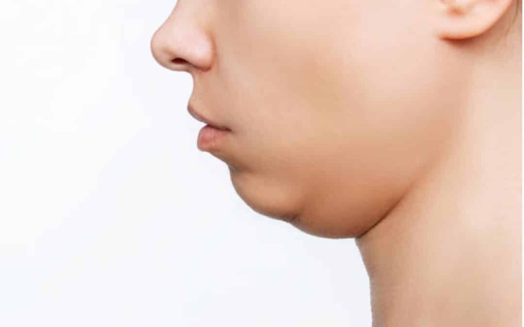 Breaking Free from the Double Chin: Options for Submental Fat Reduction
