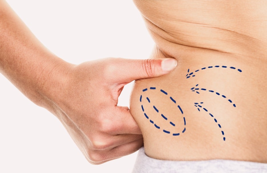 Liposuction Myths vs. Facts: Dispelling Common Misconceptions