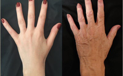 How to Address Aging Hands with Plastic Surgery