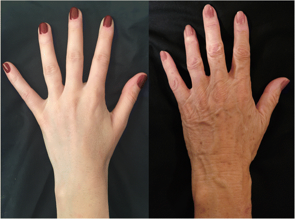 How to Address Aging Hands with Plastic Surgery