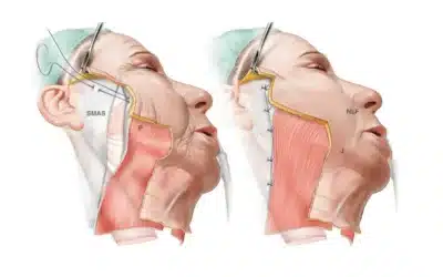 The Difference Between Traditional and Deep-Plane Facelifts