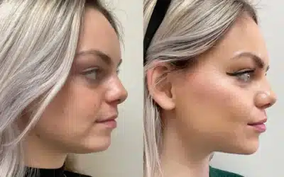 What Is a Liquid Facelift, and Is It Right for You?