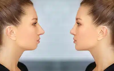 What to Expect from Jaw Reduction Surgery in Los Angeles