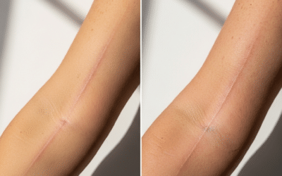 The Impact of Sun Exposure on Surgical Healing and Skin Results